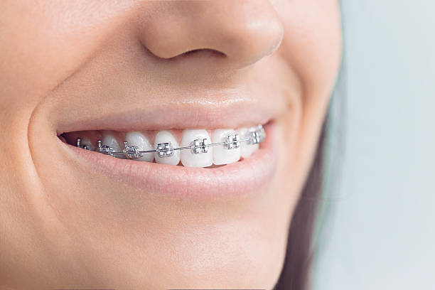 Dental Bonding in Watertown, SD